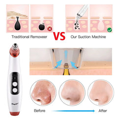 Blackhead Remover Vacuum with Visual Camera and Pore Cleaner